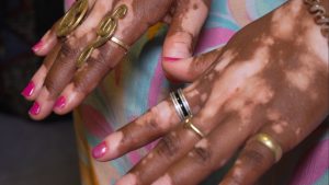 Vitiligo